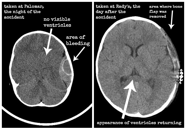 Simon's before and after CT scans